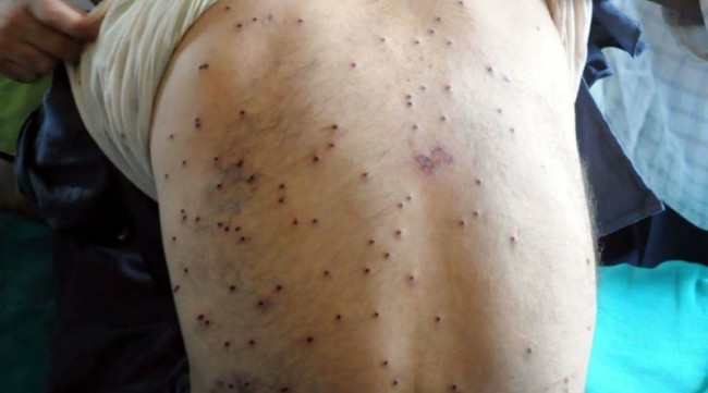 Pellet horror returns in Kashmir, 90 injured in Shopian, Kulgam