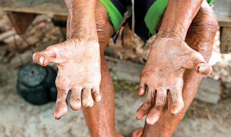 2 lakh leprosy cases reported every year, India accounts for more than half of them: WHO