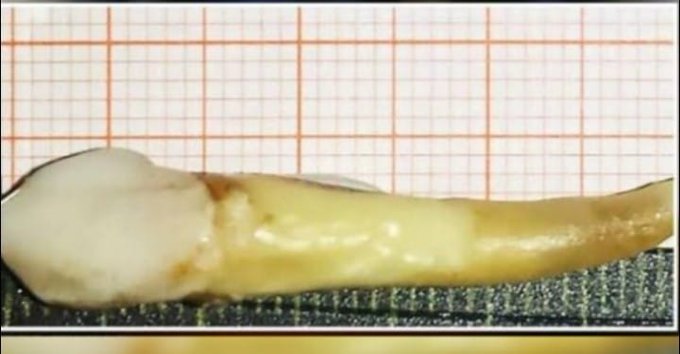 Doctors claims to extract world’s ‘longest’ tooth at Beerwah hosiptal